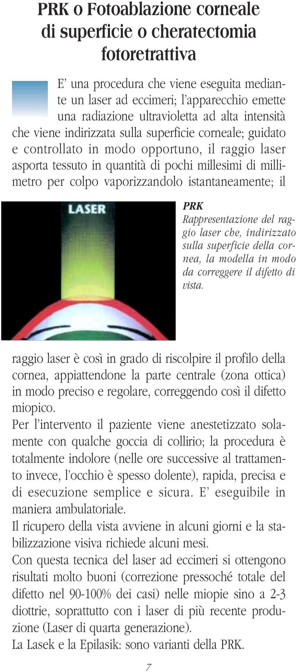 vaporizzandolo istantaneamente; il PRK Rappresentazione del raggio laser che, indirizzato sulla superficie della cornea, la modella in modo da correggere il difetto di vista.