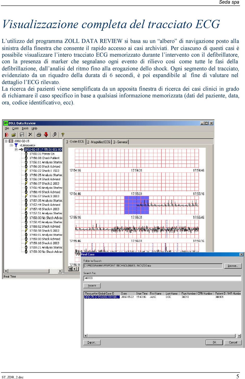 Per ciascuno di questi casi è possibile visualizzare l intero tracciato ECG memorizzato durante l intervento con il defibrillatore, con la presenza di marker che segnalano ogni evento di rilievo così