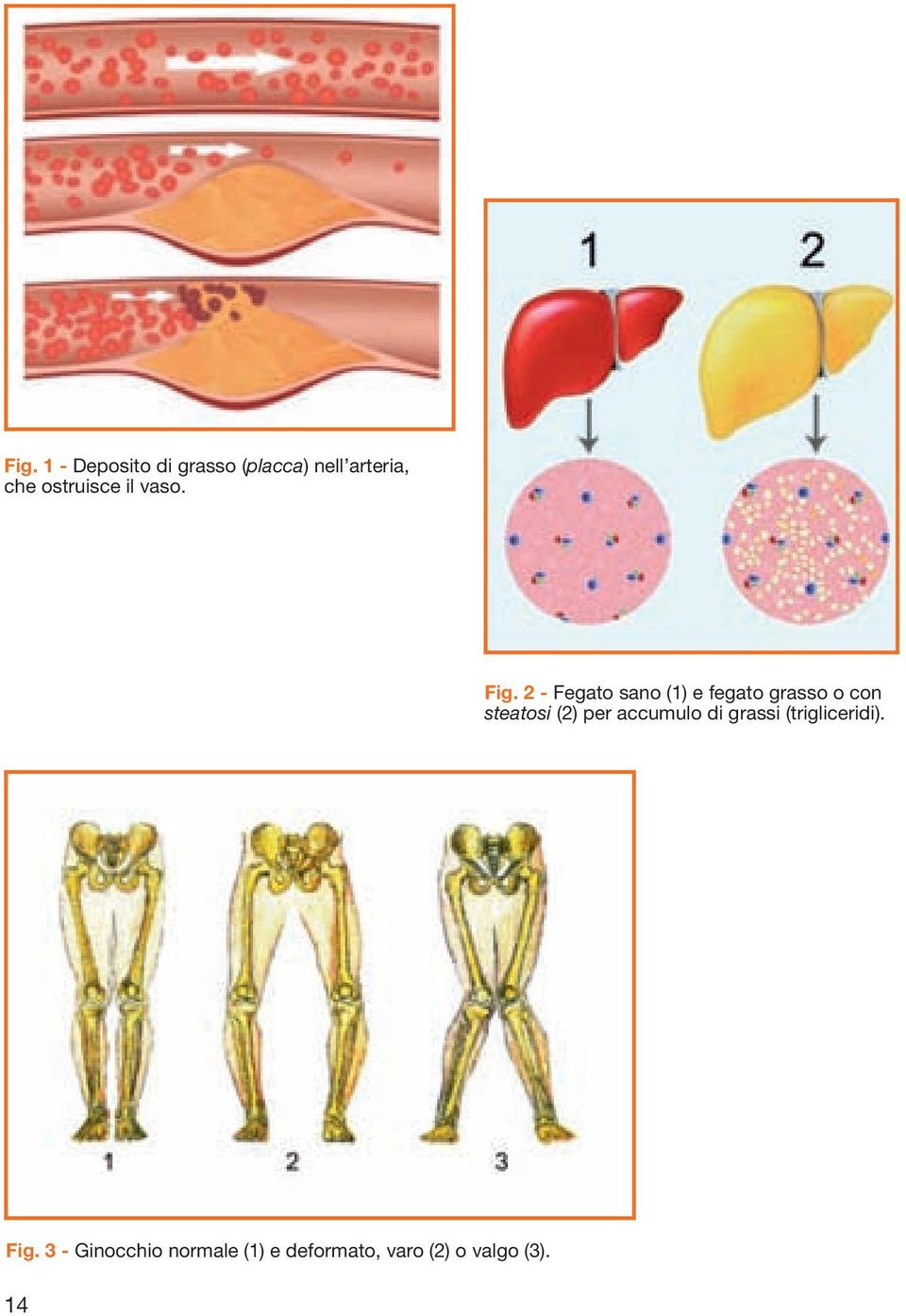 2 - Fegato sano (1) e fegato grasso o con steatosi (2) per