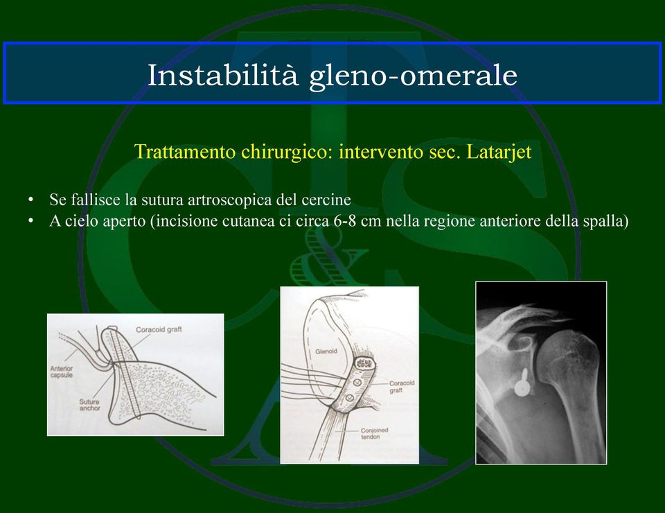 Latarjet Se fallisce la sutura artroscopica del