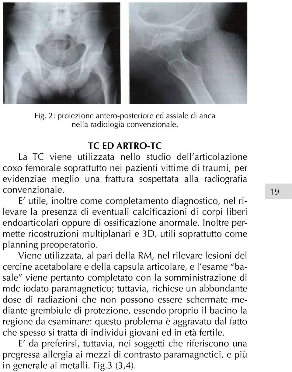 convenzionale. E utile, inoltre come completamento diagnostico, nel rilevare la presenza di eventuali calcificazioni di corpi liberi endoarticolari oppure di ossificazione anormale.