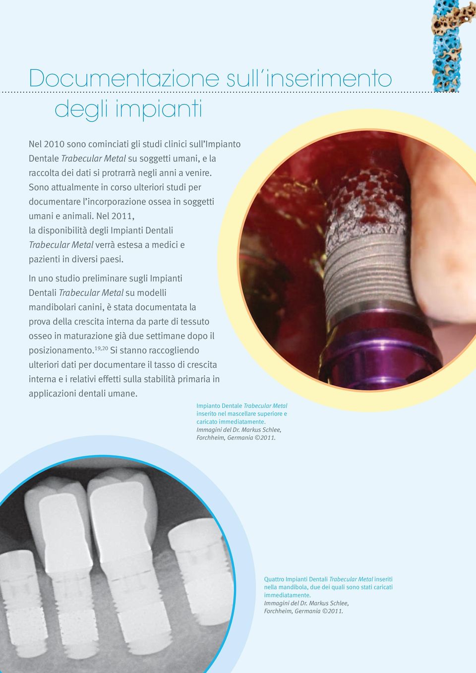Nel 2011, la disponibilità degli Impianti Dentali Trabecular Metal verrà estesa a medici e pazienti in diversi paesi.