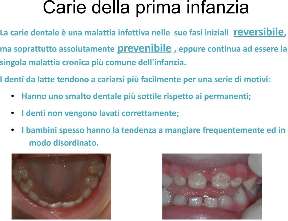 I denti da latte tendono a cariarsi più facilmente per una serie di motivi: Hanno uno smalto dentale più sottile rispetto