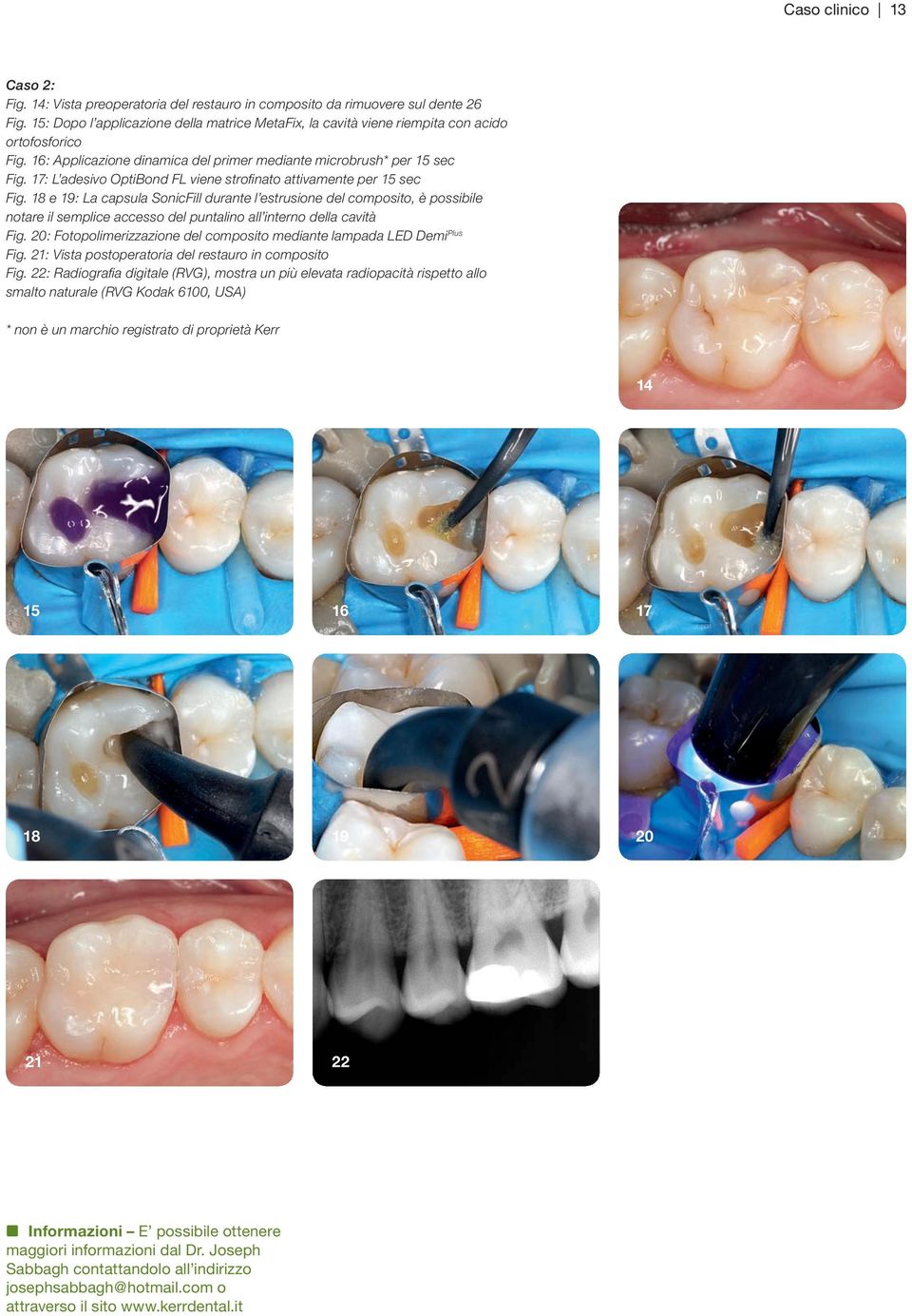 17: L adesivo OptiBond FL viene strofinato attivamente per 15 sec Fig.