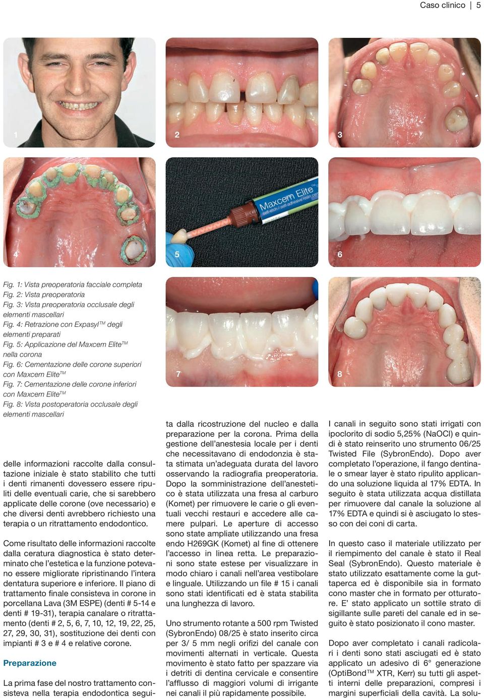 7: Cementazione delle corone inferiori con Maxcem Elite TM Fig.