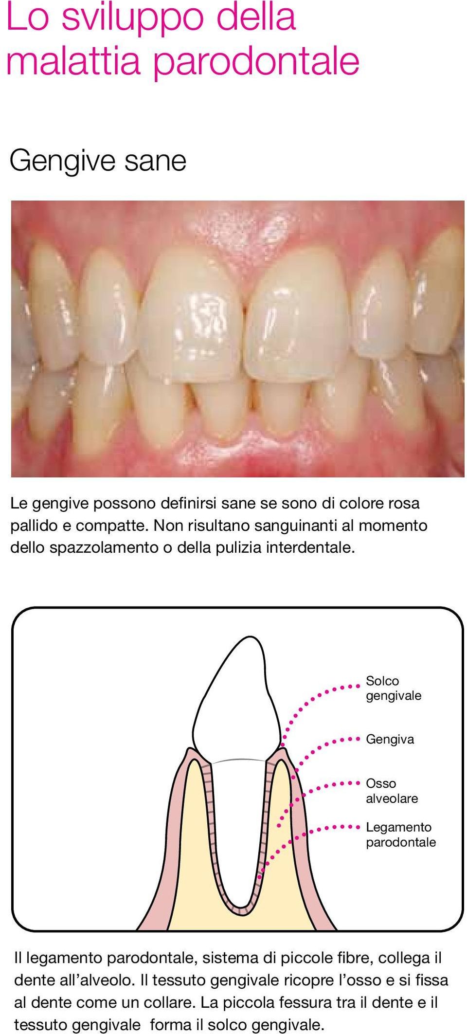 Solco gengivale Gengiva Osso alveolare Legamento parodontale Il legamento parodontale, sistema di piccole fibre, collega il