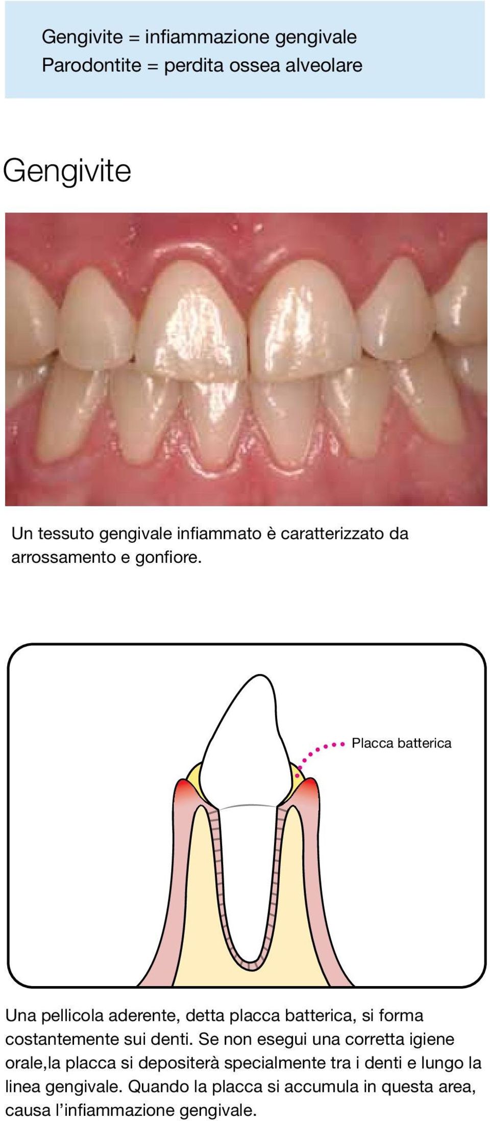 Placca batterica Una pellicola aderente, detta placca batterica, si forma costantemente sui denti.