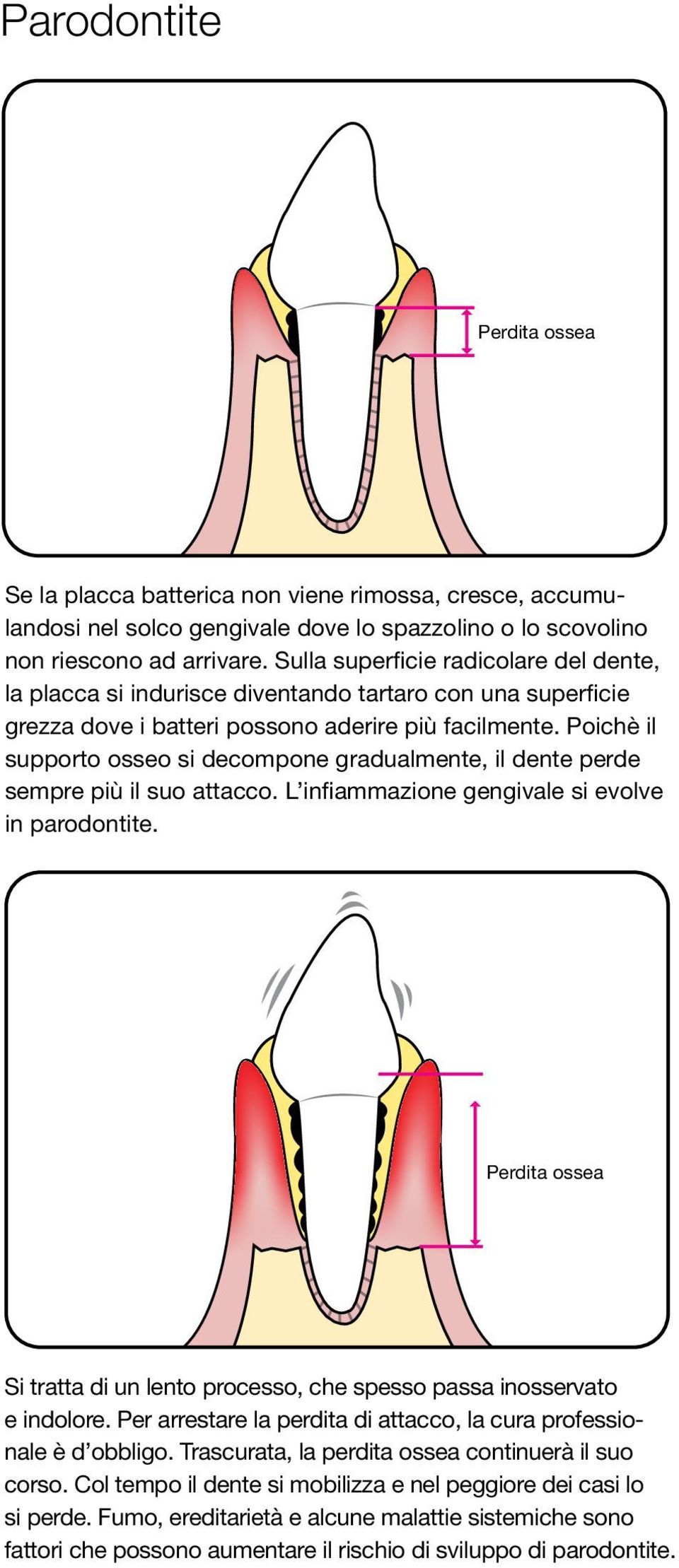 Poichè il supporto osseo si decompone gradualmente, il dente perde sempre più il suo attacco. L infiammazione gengivale si evolve in parodontite.
