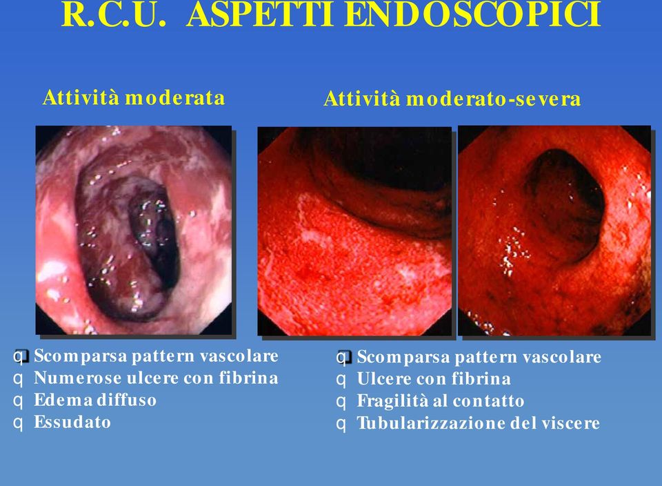 Scomparsa pattern vascolare q Numerose ulcere con fibrina q Edema