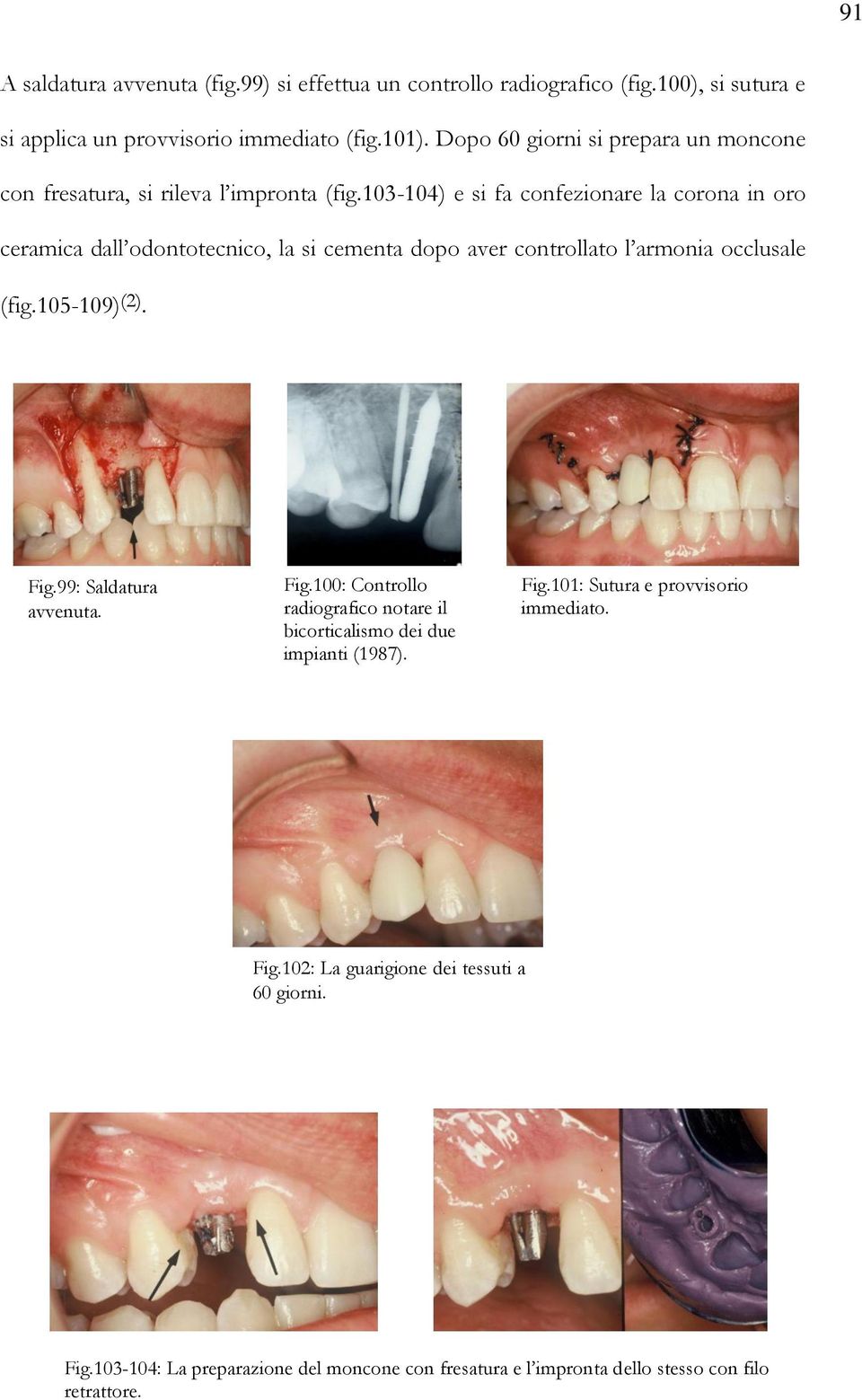 103-104) e si fa confezionare la corona in oro ceramica dall odontotecnico, la si cementa dopo aver controllato l armonia occlusale (fig.105-109) (2). Fig.