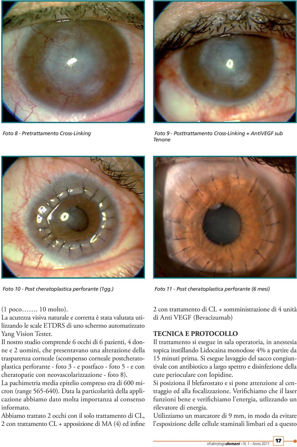 La acutezza visiva naturale e corretta è stata valutata utilizzando le scale ETDRS di uno schermo automatizzato Yang Vision Tester.