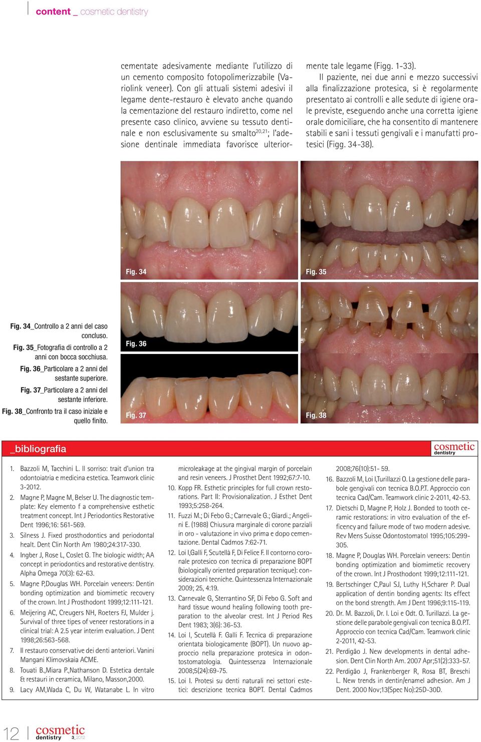 esclusivamente su smalto 20,21 ; l adesione dentinale immediata favorisce ulteriormente tale legame (Figg. 1-33).