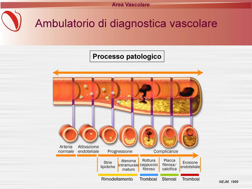 intramurale cappuccio maturo fibroso Placca fibrosa/ calcifica