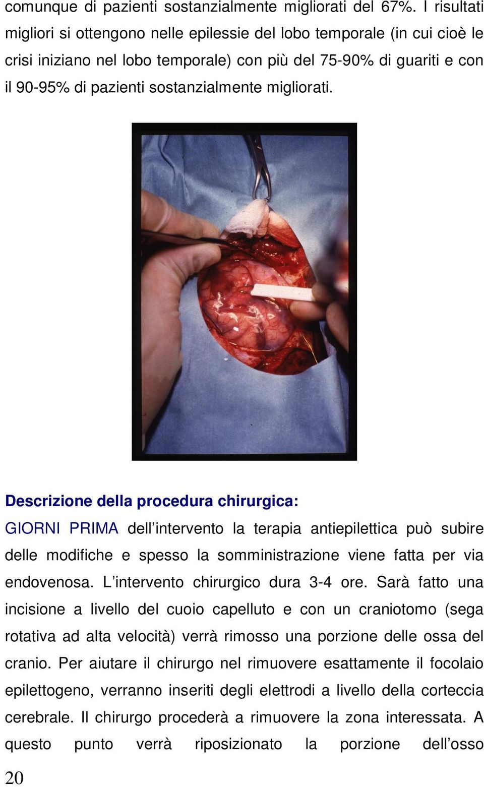 migliorati. Descrizione della procedura chirurgica: GIORNI PRIMA dell intervento la terapia antiepilettica può subire delle modifiche e spesso la somministrazione viene fatta per via endovenosa.