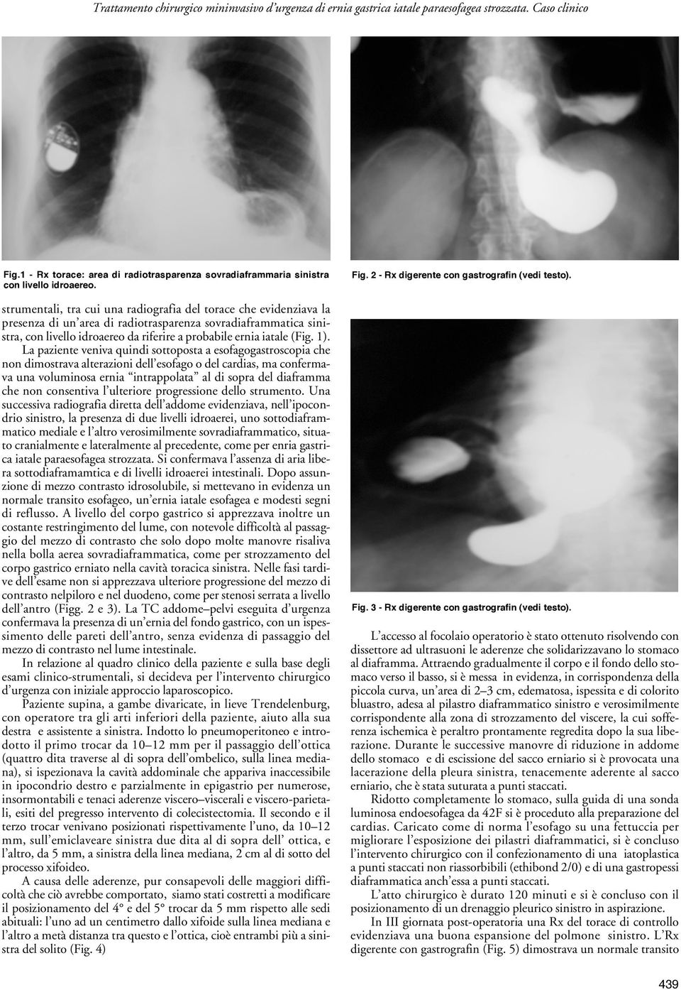 1). La paziente veniva quindi sottoposta a esofagogastroscopia che non dimostrava alterazioni dell esofago o del cardias, ma confermava una voluminosa ernia intrappolata al di sopra del diaframma che