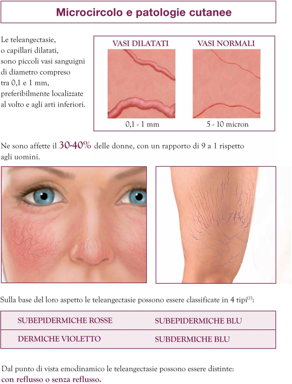 VASI DILATATI VASI NORMALI 0,1-1 mm 5-10 micron Ne sono affette il 30-40% delle donne, con un rapporto di 9 a 1 rispetto agli uomini.