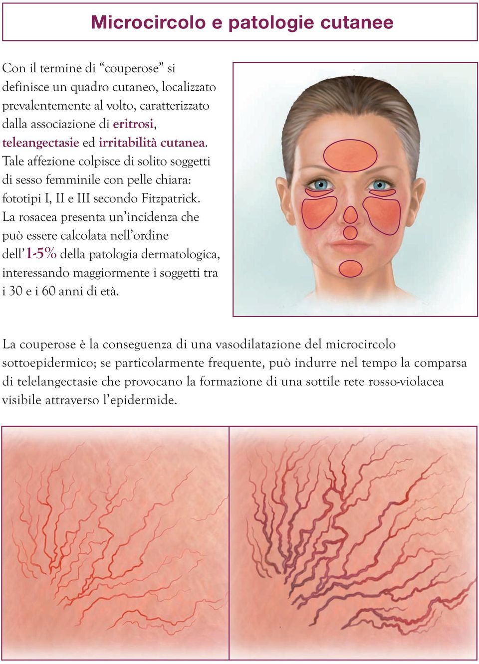 La rosacea presenta un incidenza che può essere calcolata nell ordine dell 1-5% della patologia dermatologica, interessando maggiormente i soggetti tra i 30 e i 60 anni di età.