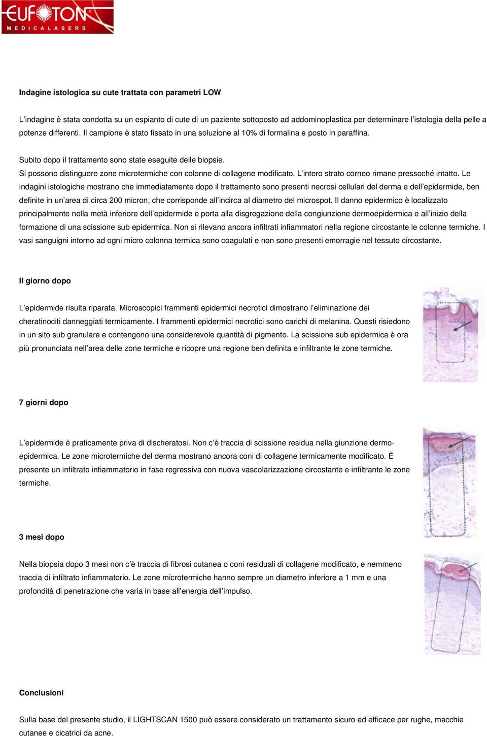 Si possono distinguere zone microtermiche con colonne di collagene modificato. L intero strato corneo rimane pressoché intatto.