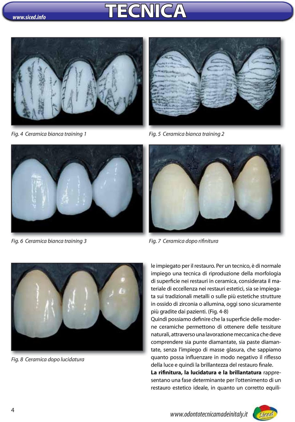 Per un tecnico, è di normale impiego una tecnica di riproduzione della morfologia di superficie nei restauri in ceramica, considerata il materiale di eccellenza nei restauri estetici, sia se