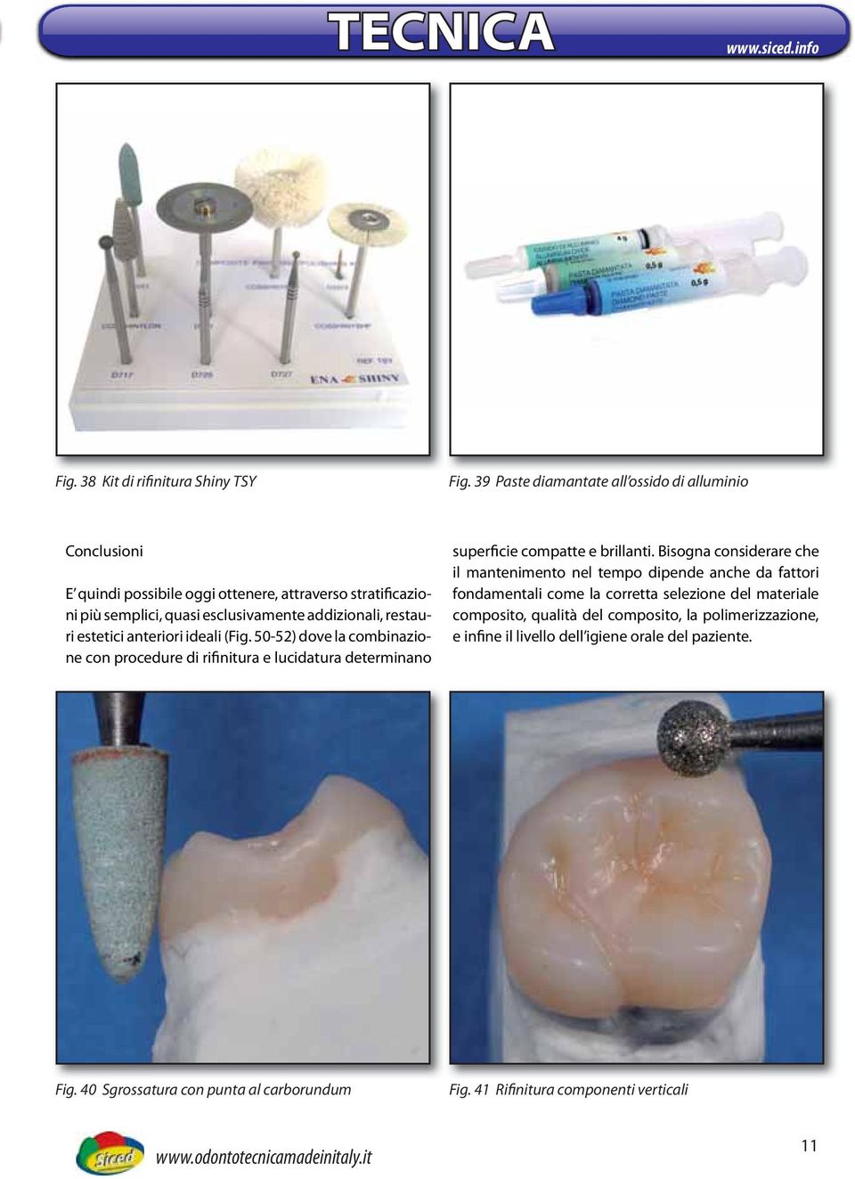 estetici anteriori ideali (Fig. 50-52) dove la combinazione con procedure di rifinitura e lucidatura determinano superficie compatte e brillanti.