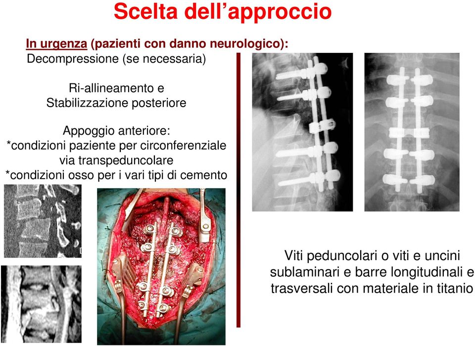 paziente per circonferenziale via transpeduncolare *condizioni osso per i vari tipi di