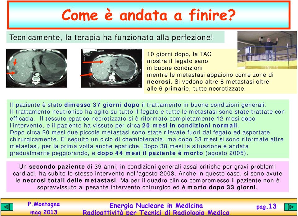 Il trattamento neutronico ha agito su tutto il fegato e tutte le metastasi sono state trattate con efficacia.