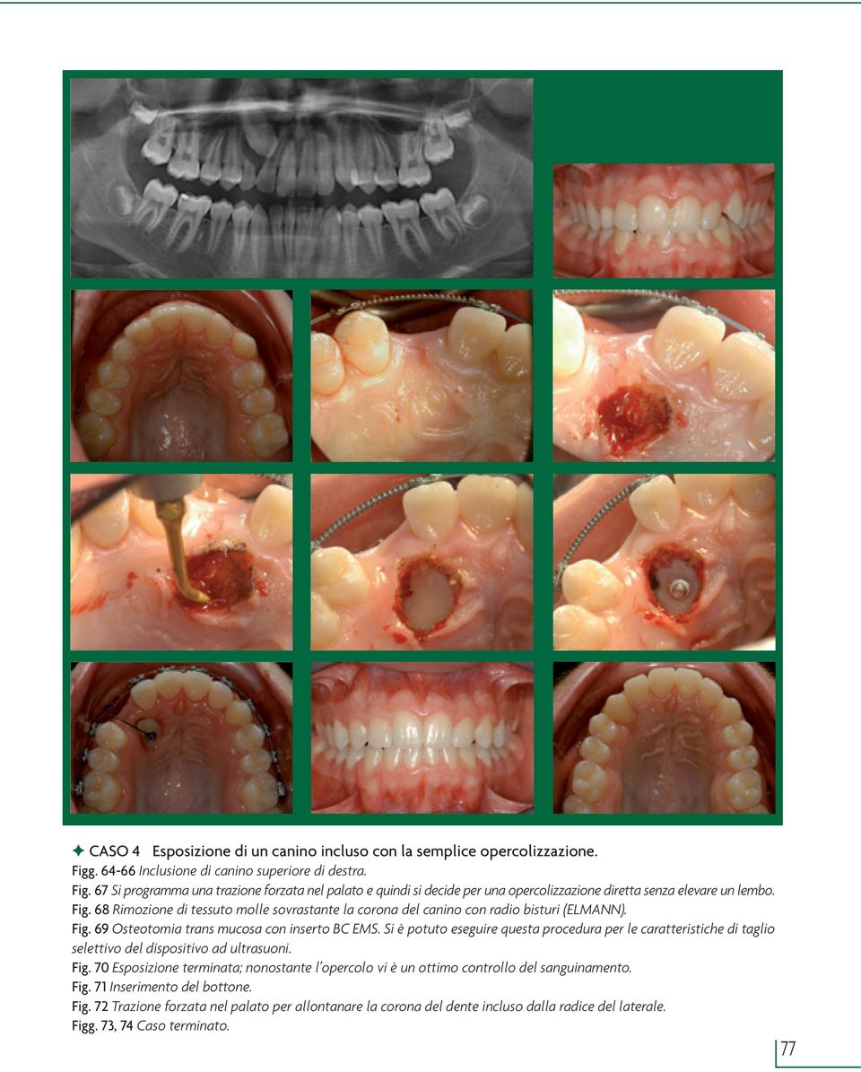 Fig. 69 Osteotomia trans mucosa con inserto BC EMS. Si è potuto eseguire questa procedura per le caratteristiche di taglio selettivo del dispositivo ad ultrasuoni. Fig.