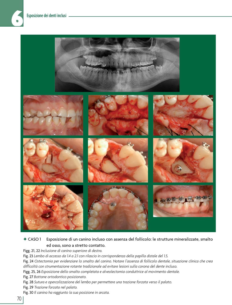 Notare l assenza di follicolo dentale, situazione clinica che crea difficoltà con strumentazione rotante tradizionale ad evitare lesioni sulla corona del dente incluso. Figg.