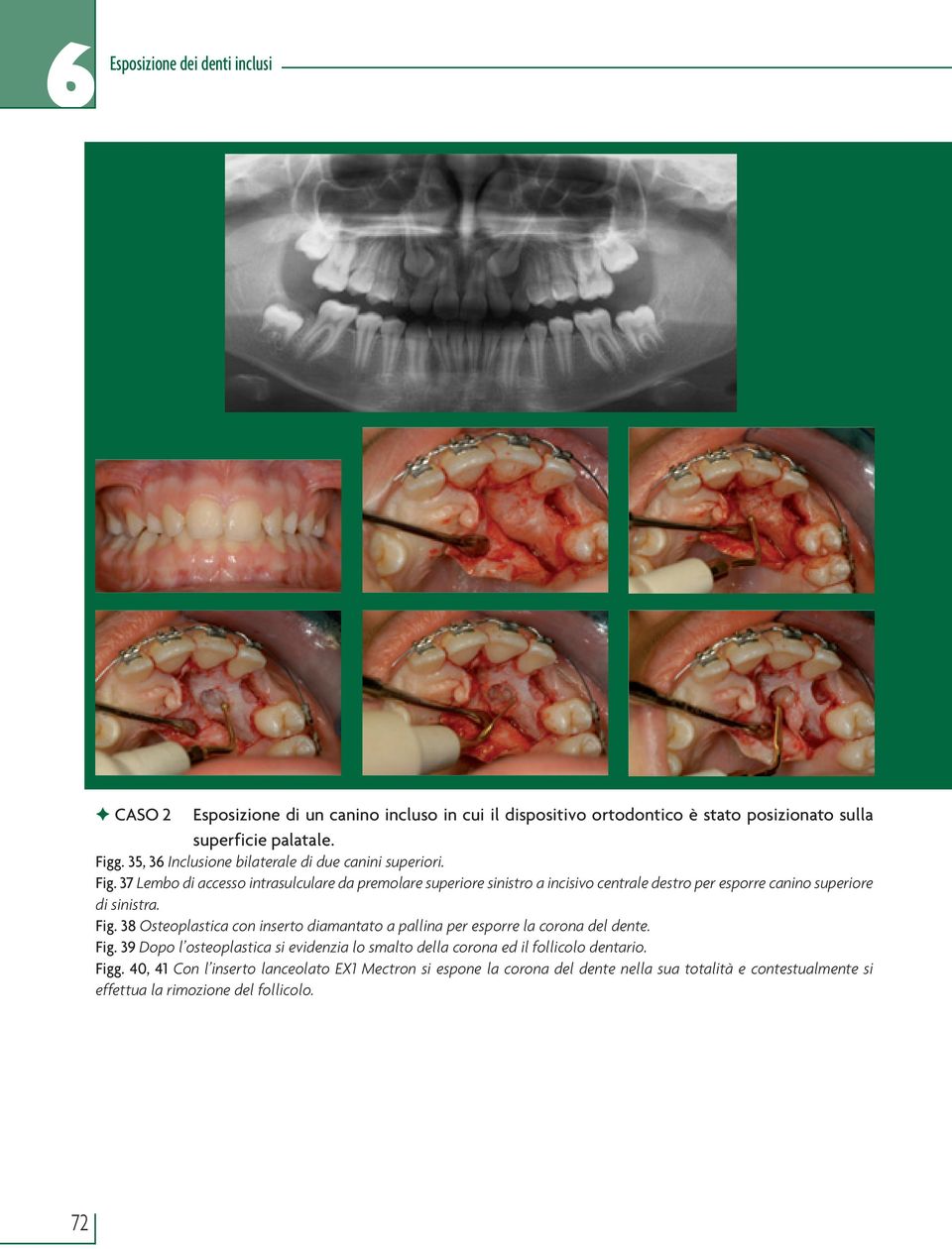 37 Lembo di accesso intrasulculare da premolare superiore sinistro a incisivo centrale destro per esporre canino superiore di sinistra. Fig.