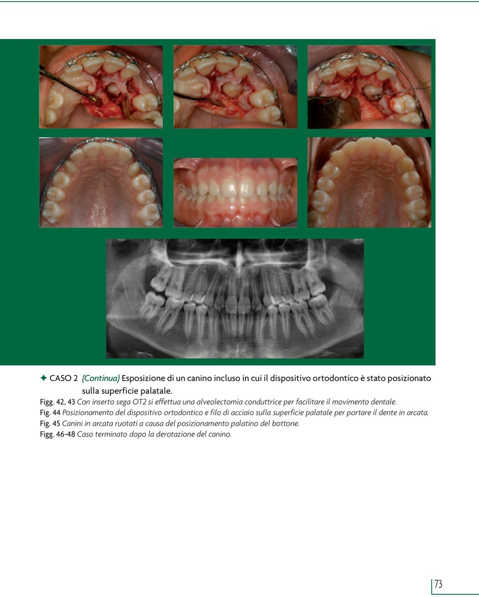 . 42, 43 Con inserto sega OT2 si effettua una alveolectomia conduttrice per facilitare il movimento dentale. Fig.