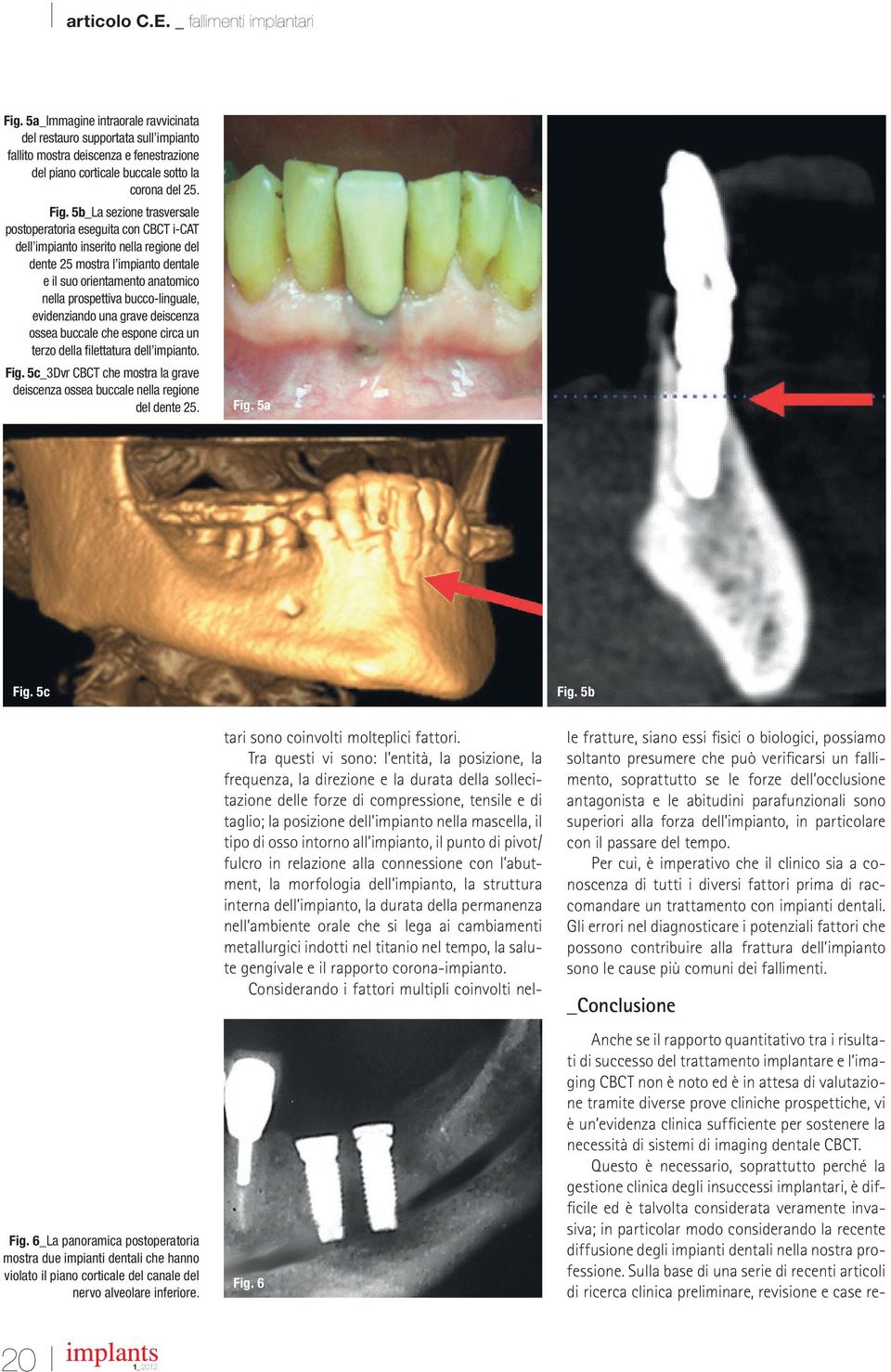 bucco-linguale, evidenziando una grave deiscenza ossea buccale che espone circa un terzo della filettatura dell impianto. Fig.