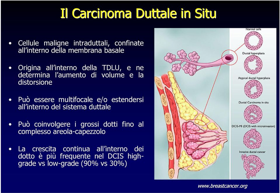 estendersi all interno del sistema duttale Può coinvolgere i grossi dotti fino al complesso areola-capezzolo La