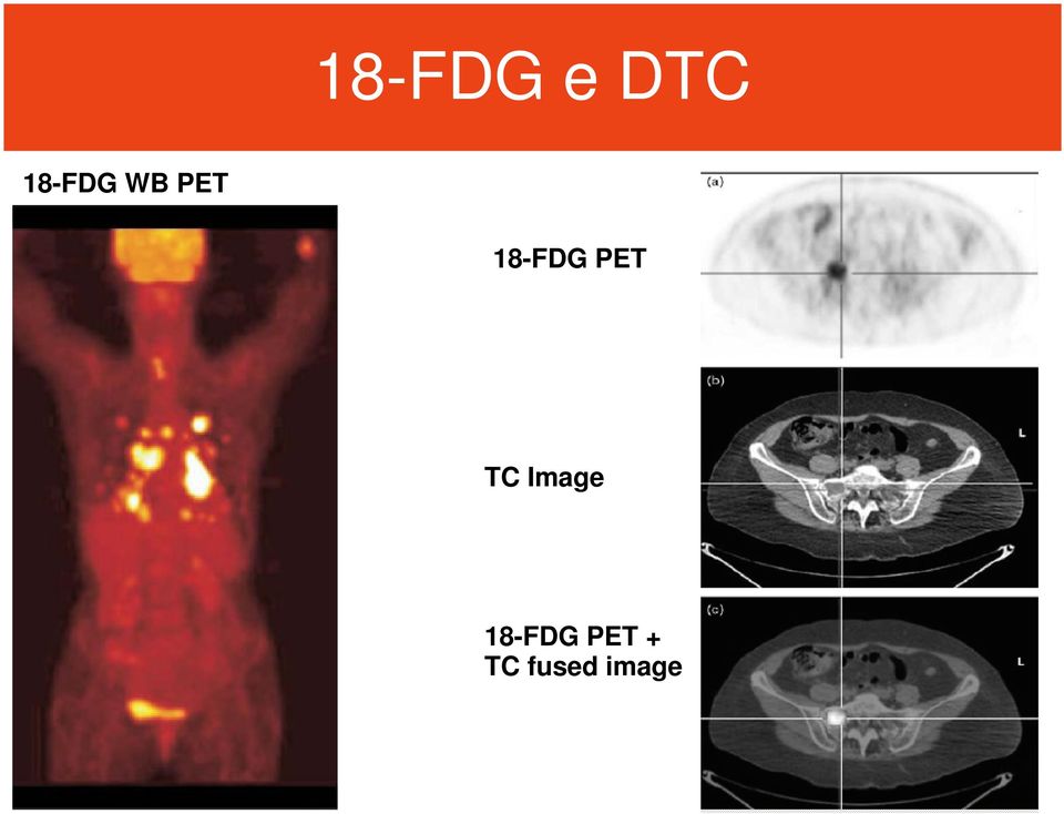 18-FDG PET TC