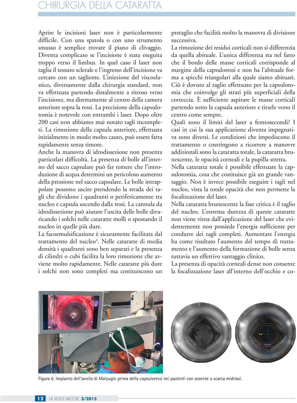 L iniezione del viscoelastico, diversamente dalla chirurgia standard, non va effettuata partendo distalmente a ritroso verso l incisione, ma direttamente al centro della camera anteriore sopra la