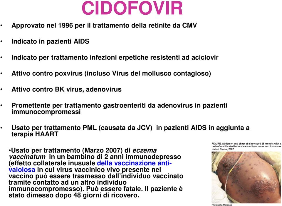 pazienti AIDS in aggiunta a terapia HAART Usato per trattamento (Marzo 2007) di eczema vaccinatum in un bambino di 2 anni immunodepresso (effetto collaterale inusuale della vaccinazione antivaiolosa