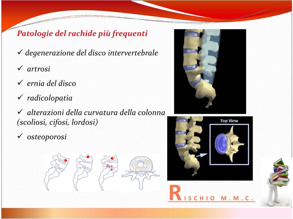 ernia del disco radicolopatia alterazioni della