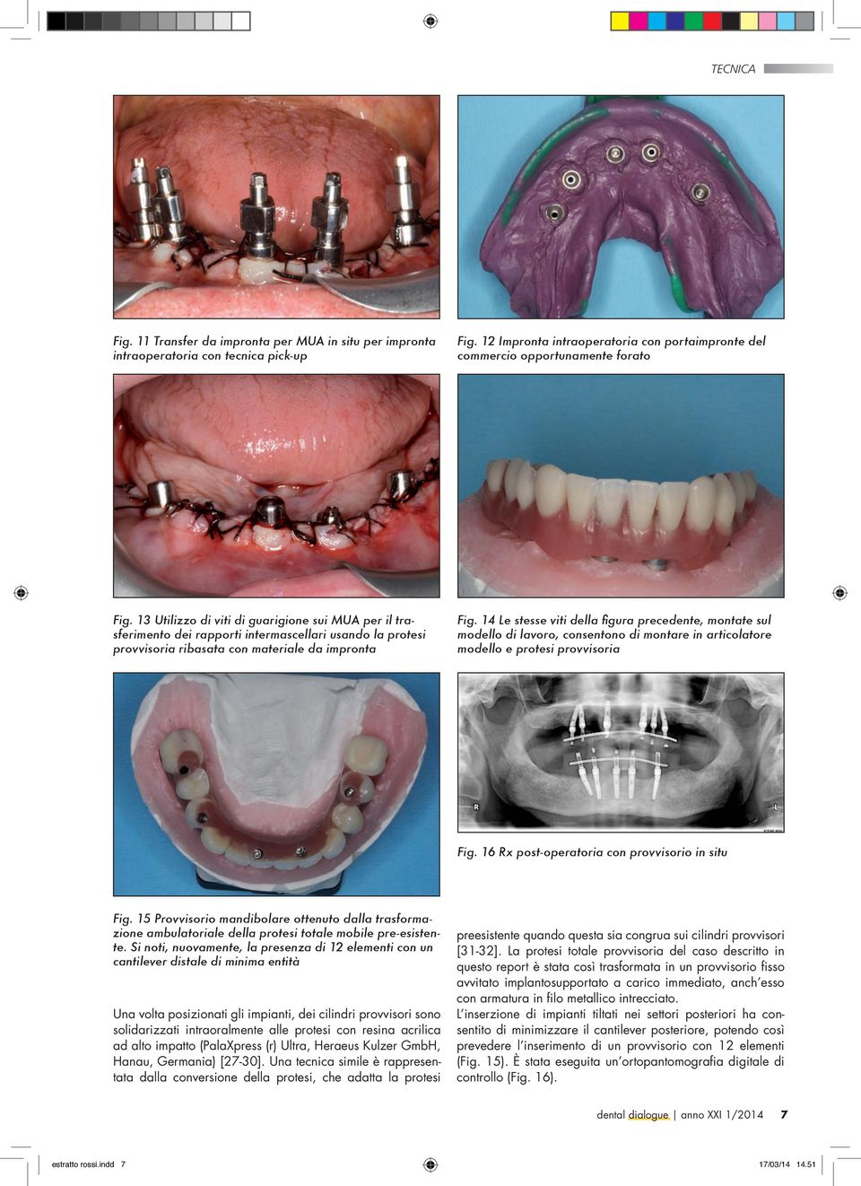 14 Le stesse viti della figura precedente, montate sul modello di lavoro, consentono di montare in articolatore modello e protesi provvisoria Fig. 16 Rx post-operatoria con provvisorio in situ Fig.