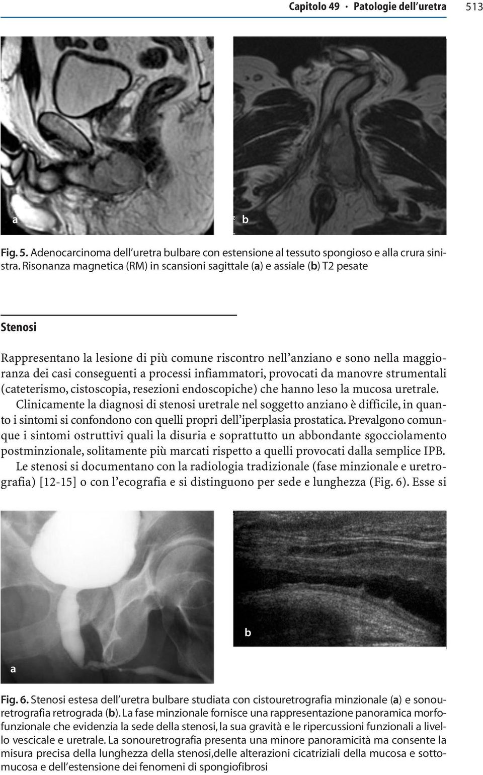 d mnovre strumentli (cteterismo, cistoscopi, resezioni endoscopiche) che hnno leso l mucos uretrle.