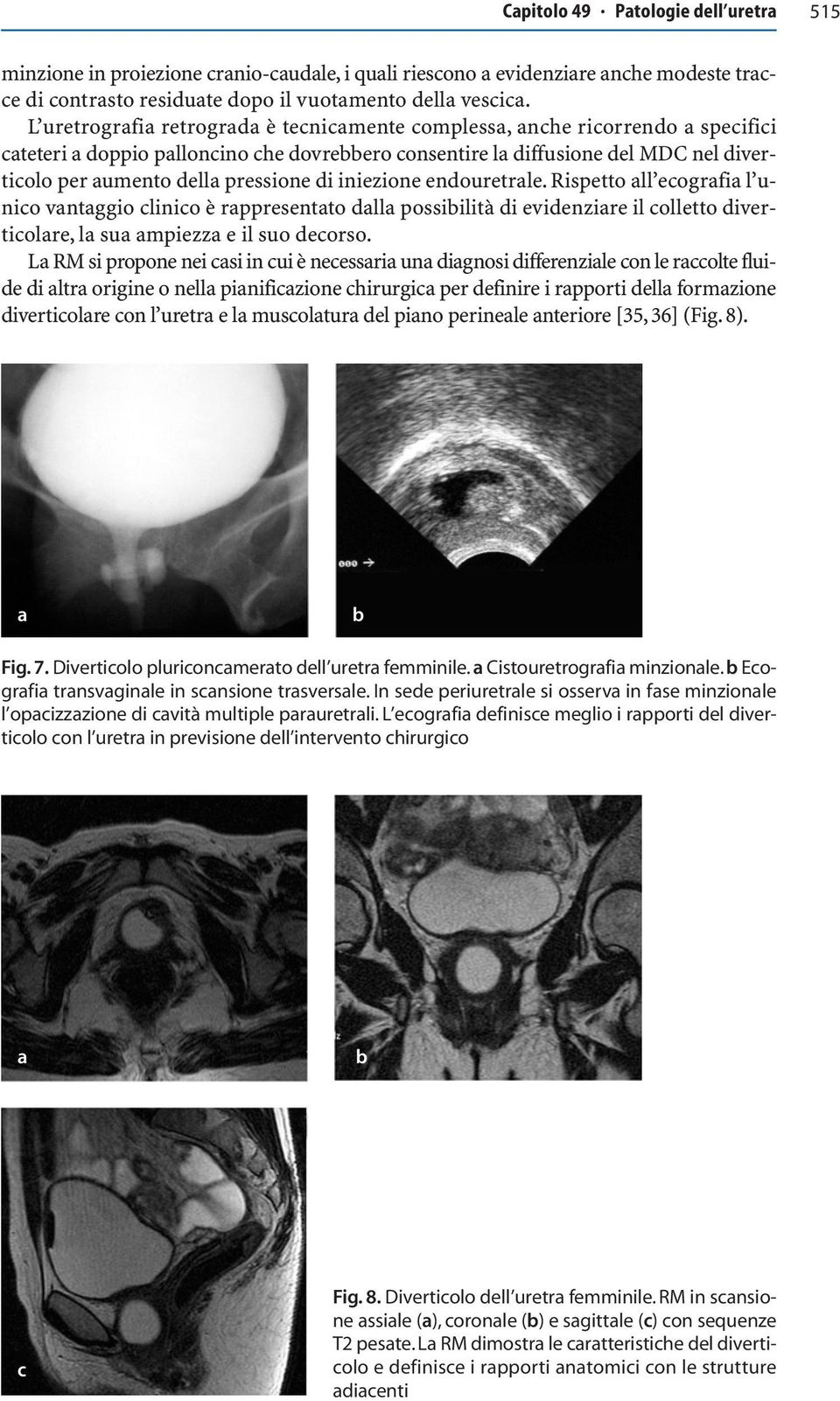 endouretrle. Rispetto ll ecogrfi l unico vntggio clinico è rppresentto dll possiilità di evidenzire il colletto diverticolre, l su mpiezz e il suo decorso.