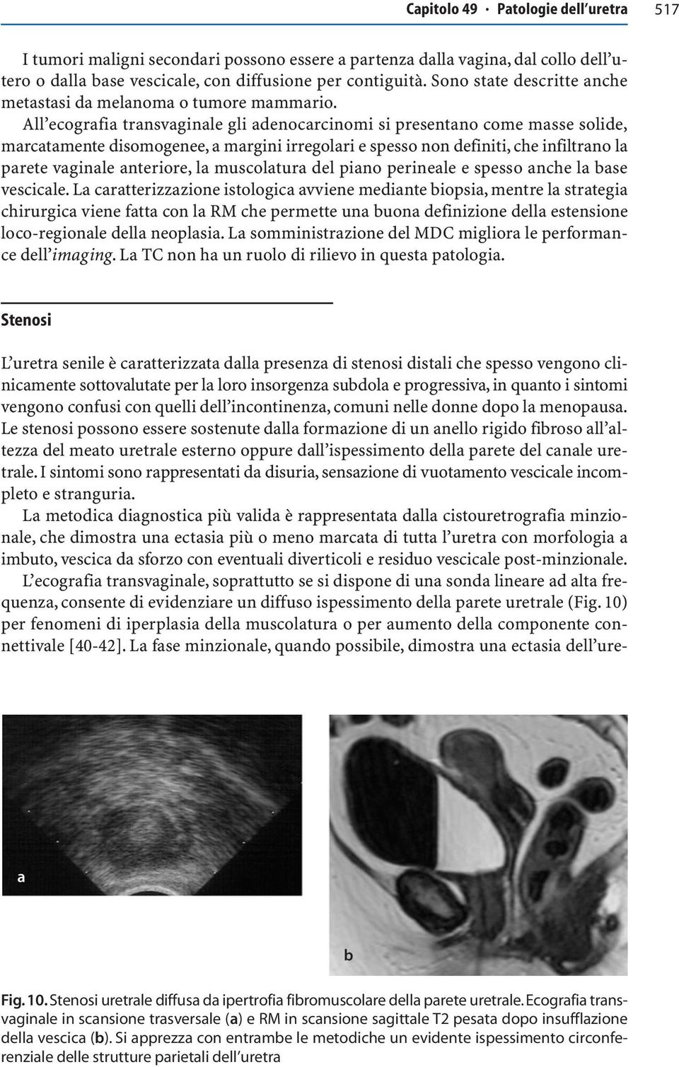 All ecogrfi trnsvginle gli denocrcinomi si presentno come msse solide, mrctmente disomogenee, mrgini irregolri e spesso non definiti, che infiltrno l prete vginle nteriore, l muscoltur del pino