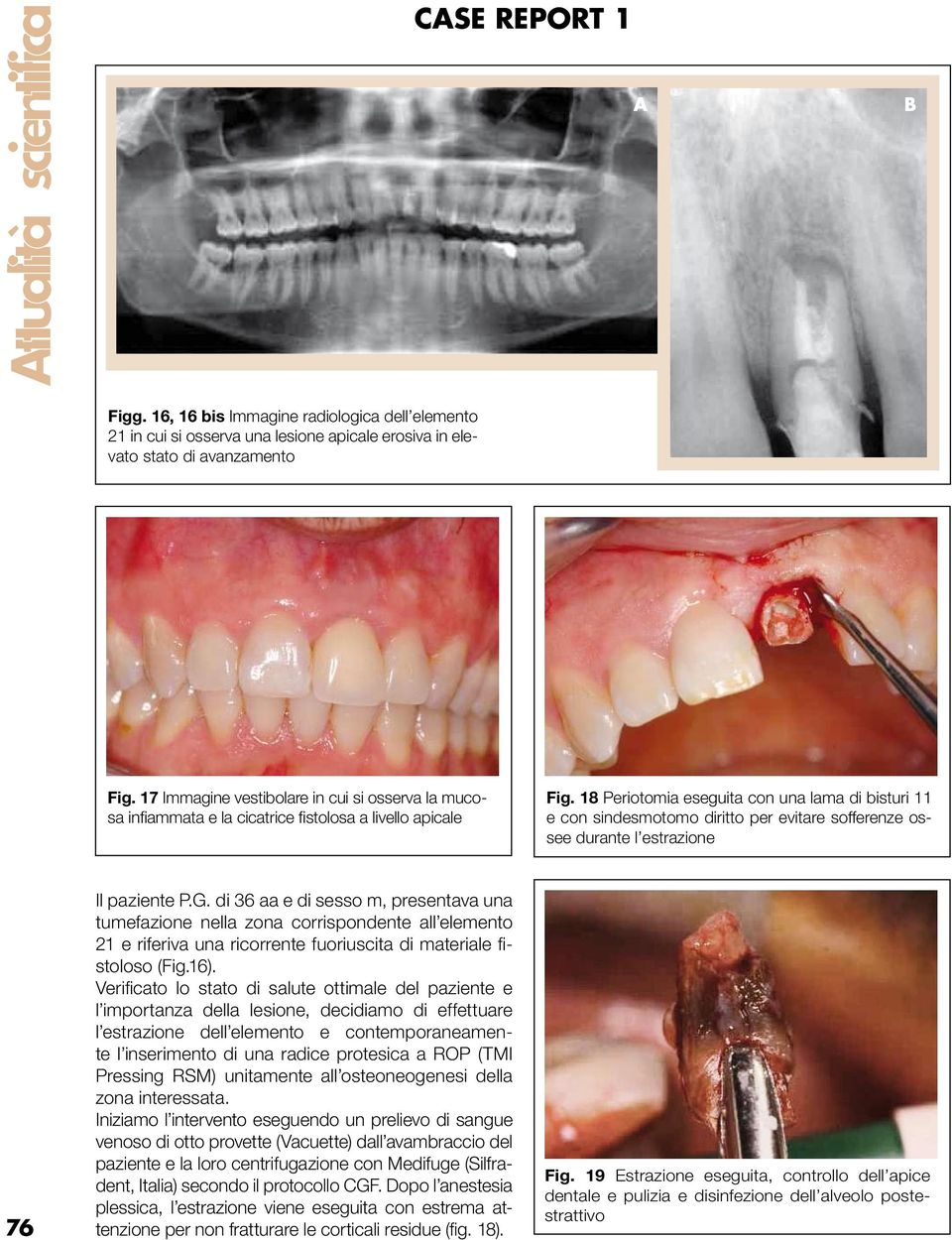 18 Periotomia eseguita con una lama di bisturi 11 e con sindesmotomo diritto per evitare sofferenze ossee durante l estrazione 76 Il paziente P.G.