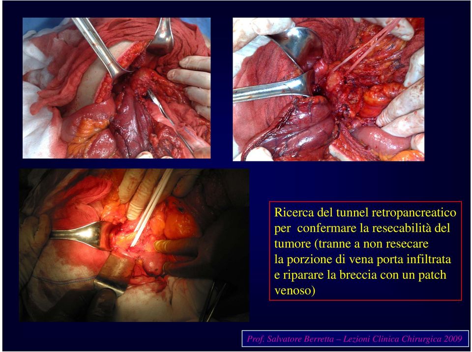 di vena porta infiltrata e riparare la breccia con un patch