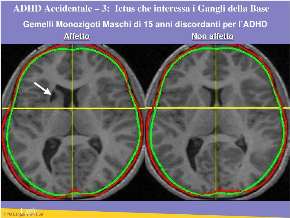 Gemelli Monozigoti Maschi di 15