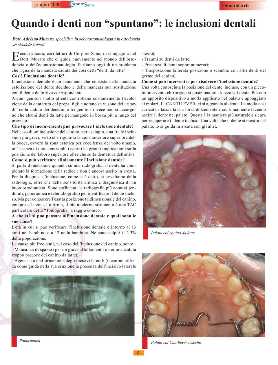 Muraro che ci guida nuovamente nel mondo dell ortodonzia e dell odontostomatologia. Parliamo oggi di un problema che riguarda la mancata caduta dei così detti denti da latte.