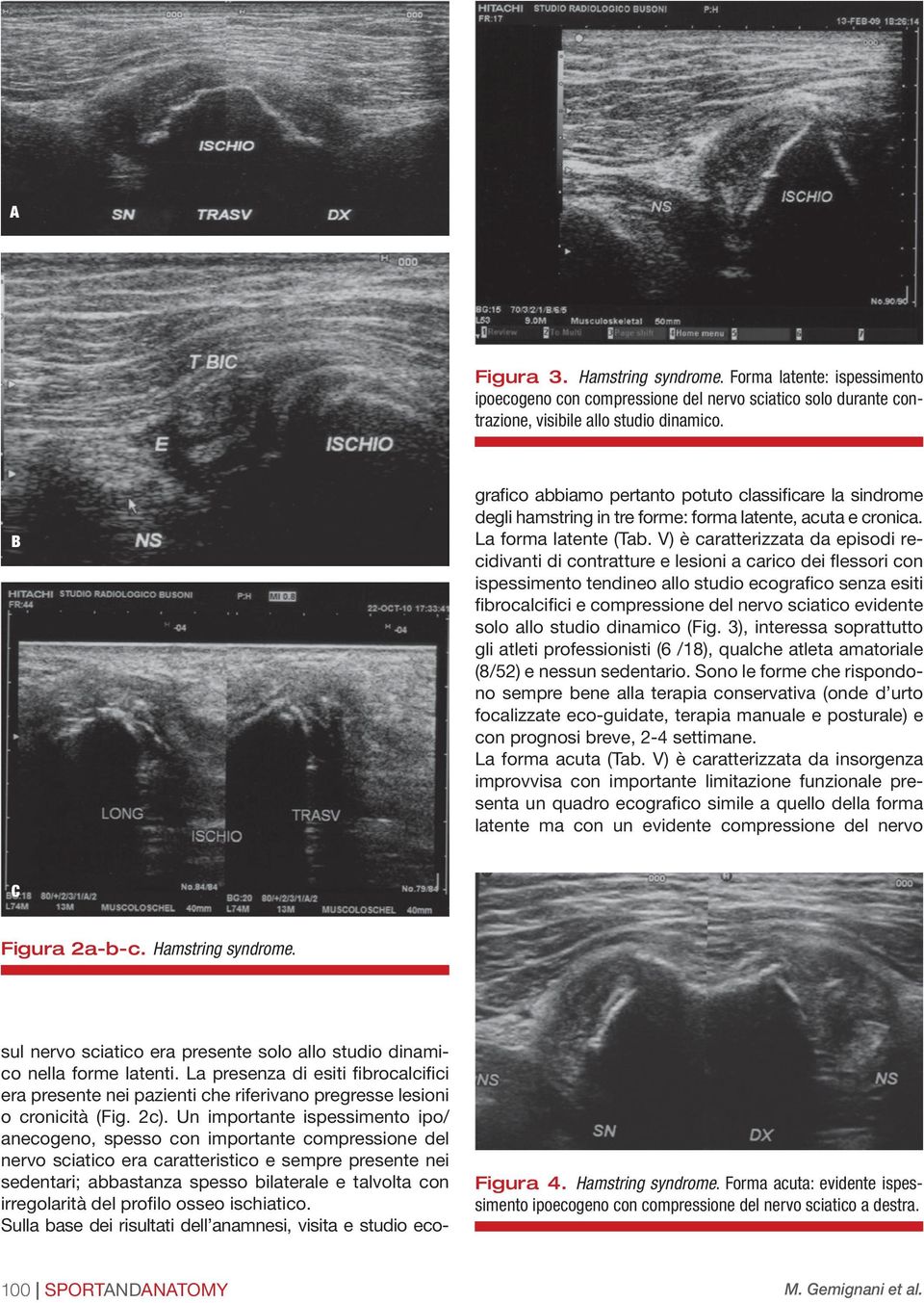 V) è caratterizzata da episodi recidivanti di contratture e lesioni a carico dei flessori con ispessimento tendineo allo studio ecografico senza esiti fibrocalcifici e compressione del nervo sciatico