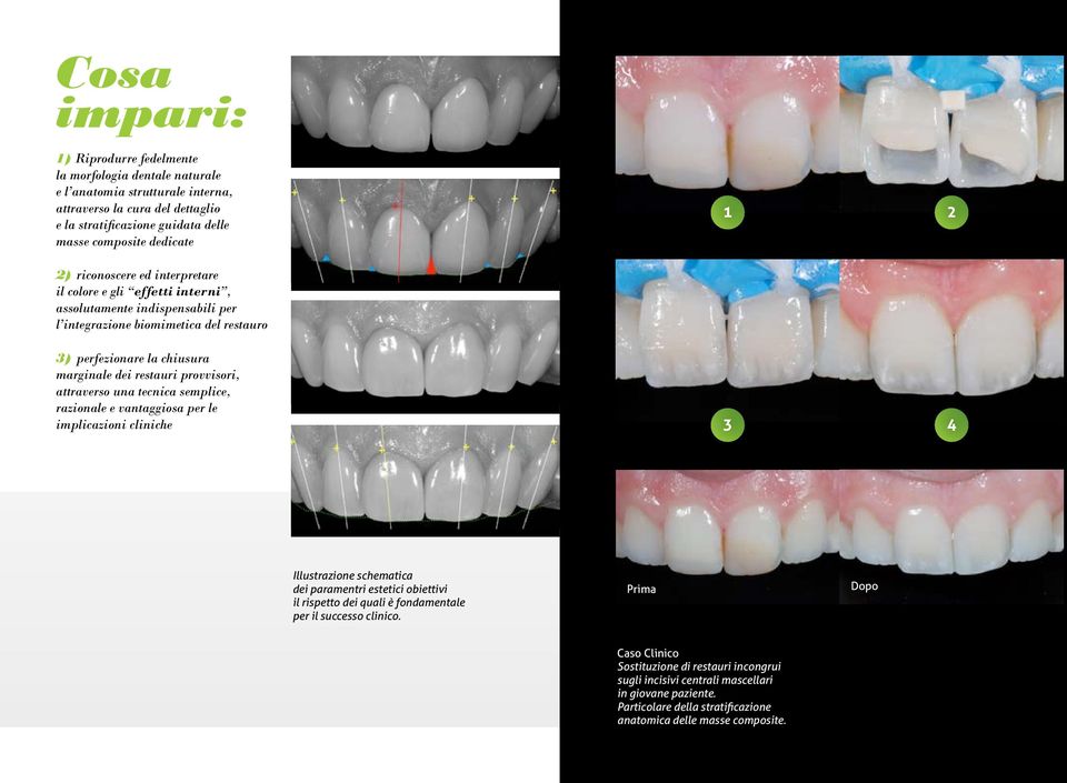 provvisori, attraverso una tecnica semplice, razionale e vantaggiosa per le implicazioni cliniche 3 4 Illustrazione schematica dei paramentri estetici obiettivi il rispetto dei quali è fondamentale