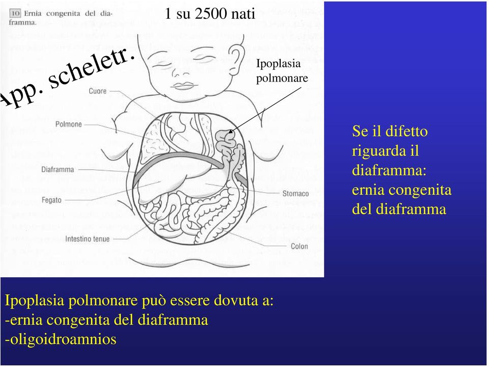 diaframma: ernia congenita del diaframma Ipoplasia