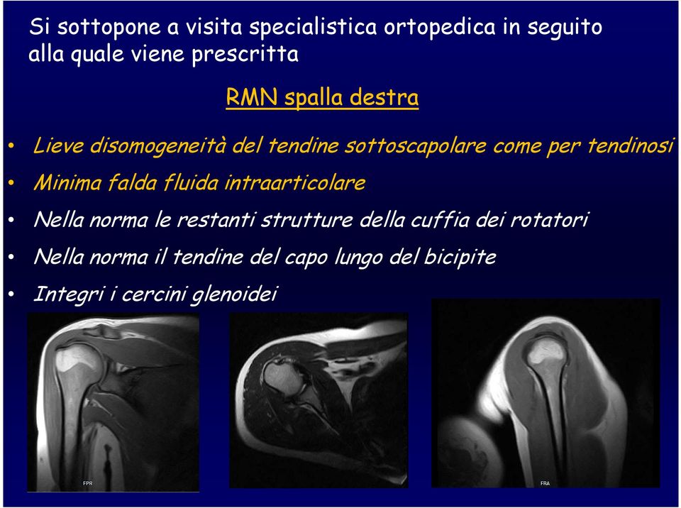 Minima falda fluida intraarticolare Nella norma le restanti strutture della cuffia