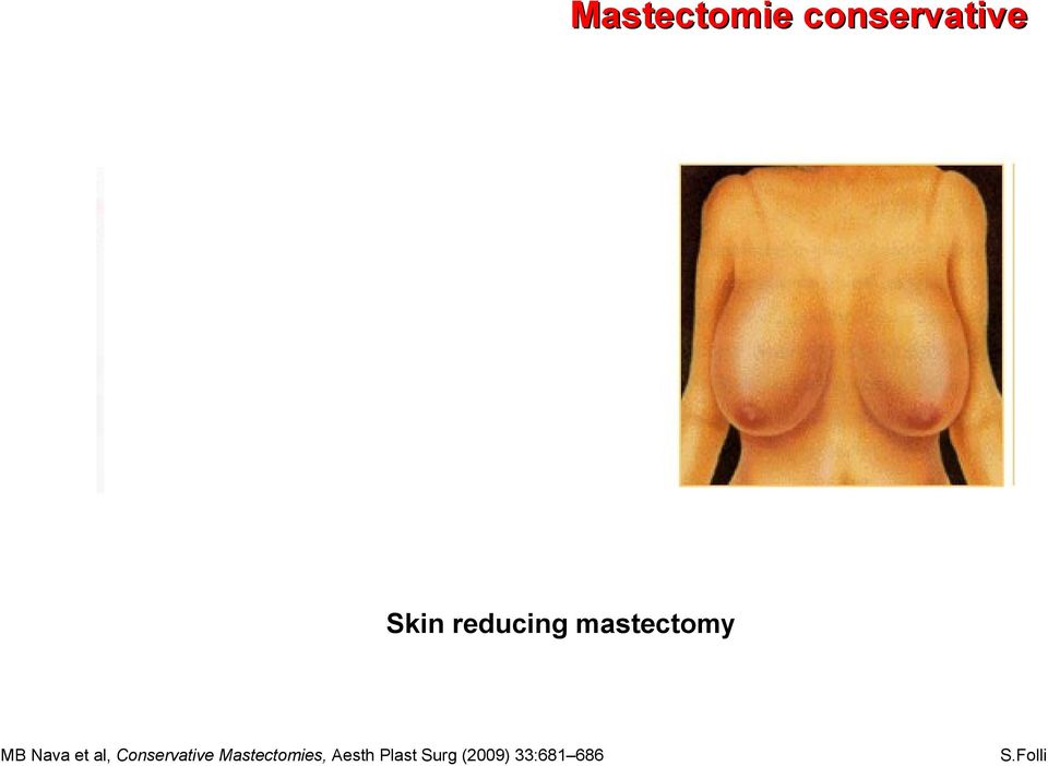 al, Conservative Mastectomies,