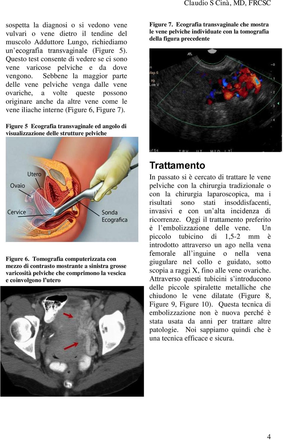 Sebbene la maggior parte delle vene pelviche venga dalle vene ovariche, a volte queste possono originare anche da altre vene come le vene iliache interne (Figure 6, Figure 7)